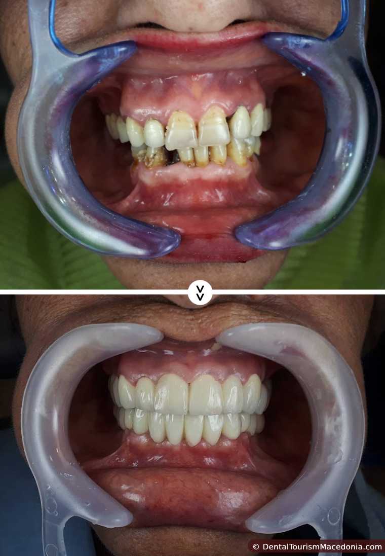 Full mouth rehabilitation with Titanium composite CAD CAM crowns.