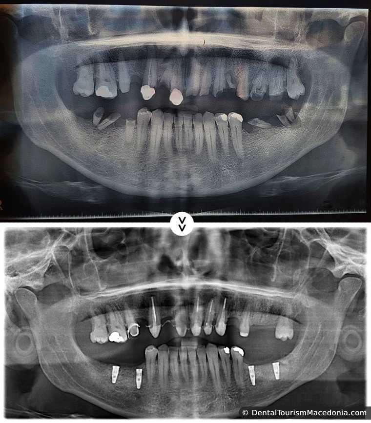 Total restoration upper jaw, combined work, Porcelain fused to metal crowns on implants and natural teeth.