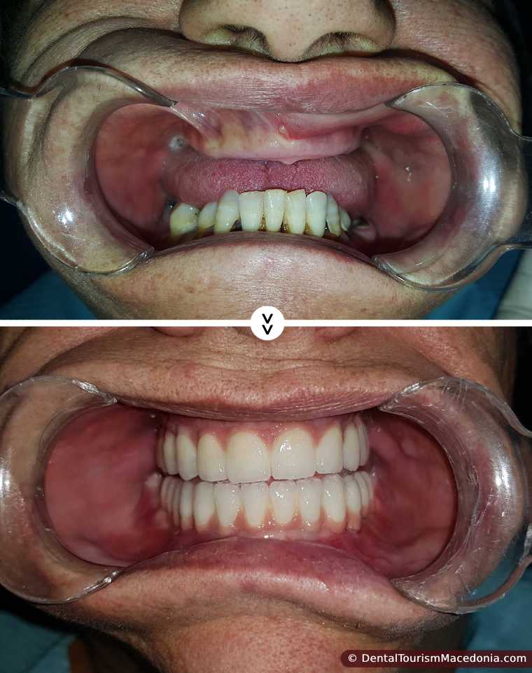 Full mouth rehabilitation with the ALL on 6 sistem and zirconia ceramic CAD CAM crowns without artificial gum.